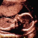 Court Upholds Louisiana Law Requiring Abortion Doctors to Have Admitting Privileges With Nearby Hospitals