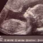 Ohio Bill Would Ban Abortion Based on a Fetal Down Syndrome Diagnosis